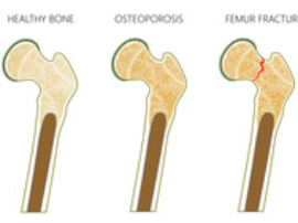 Guía Completa sobre la Extensión de Femoral en Máquina: Beneficios y Ejercicios